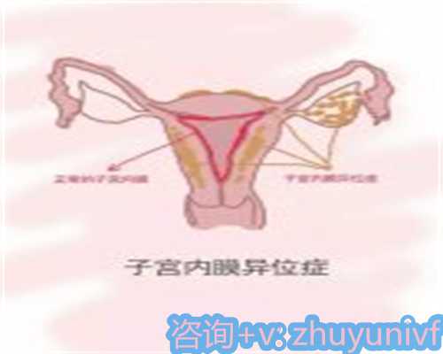 南京正规的代怀孕中心,早产儿黄疸需要治疗吗